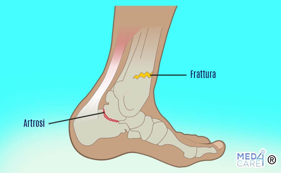 Frattura alla caviglia, dolore alla caviglia, artrosi della caviglia