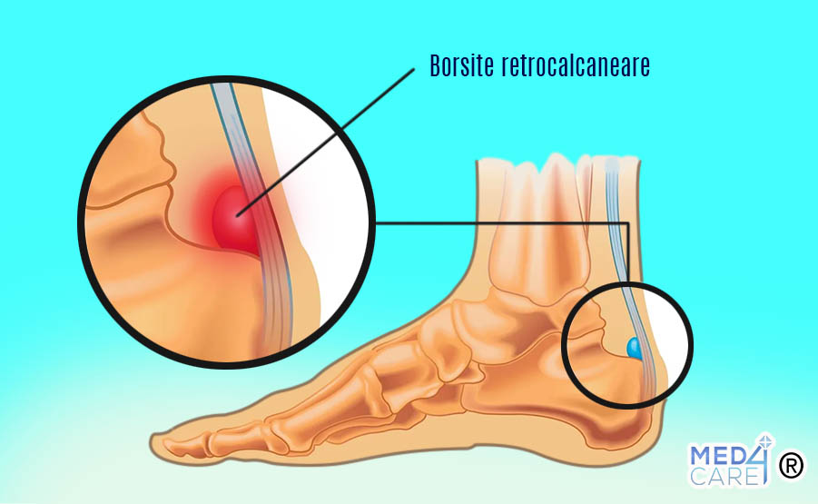 Borsite alla caviglia, dolore alla caviglia, borsite retrocalcaneare