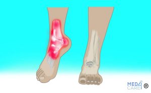 Scopri di più sull'articolo Il dolore alla caviglia