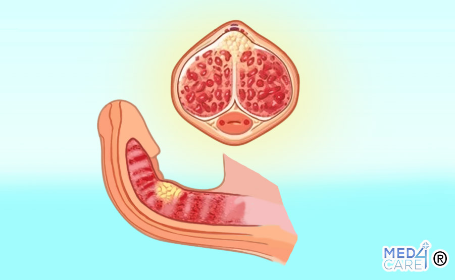 Pene curvo, malattia di Peyronie