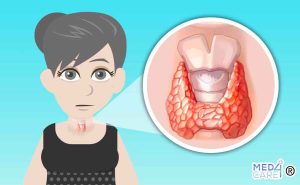 Scopri di più sull'articolo Tiroidite di Hashimoto