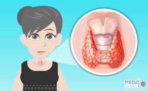 Scopri di più sull'articolo Tiroidite di Hashimoto