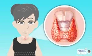 Scopri di più sull'articolo Tiroidite di Hashimoto