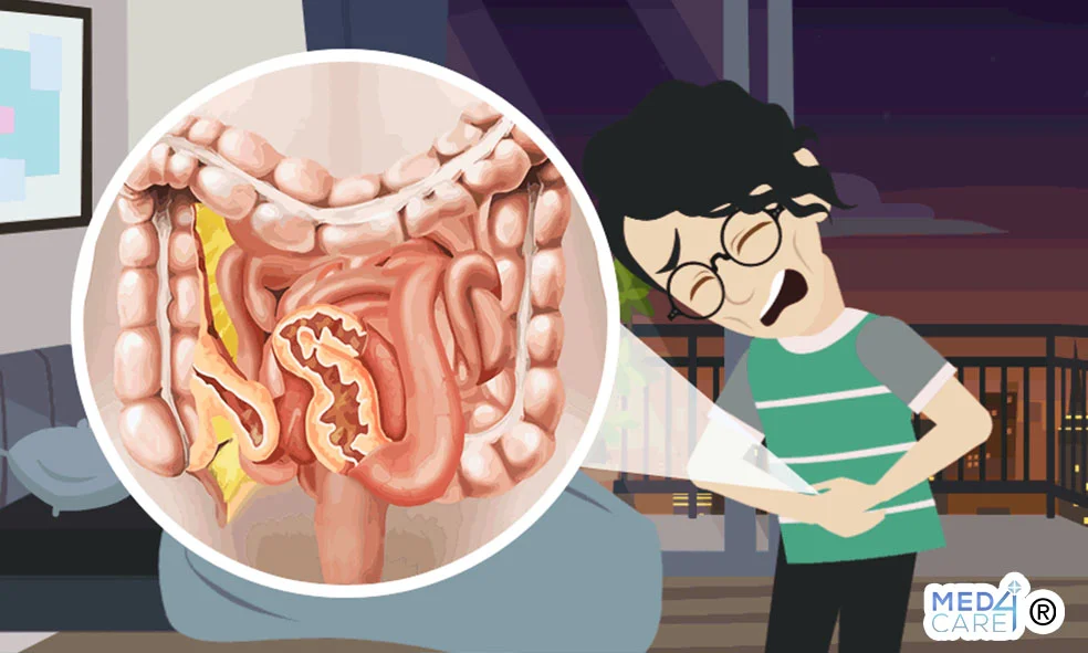 Morbo di Crohn