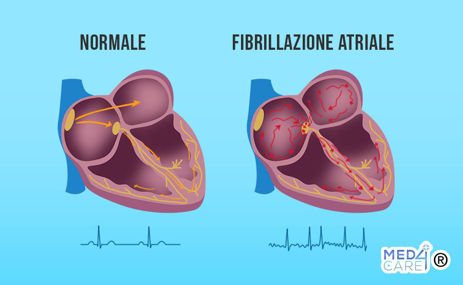 Fibrillazione atriale, malattie cardiache, aritmie cardiache, cardiologia