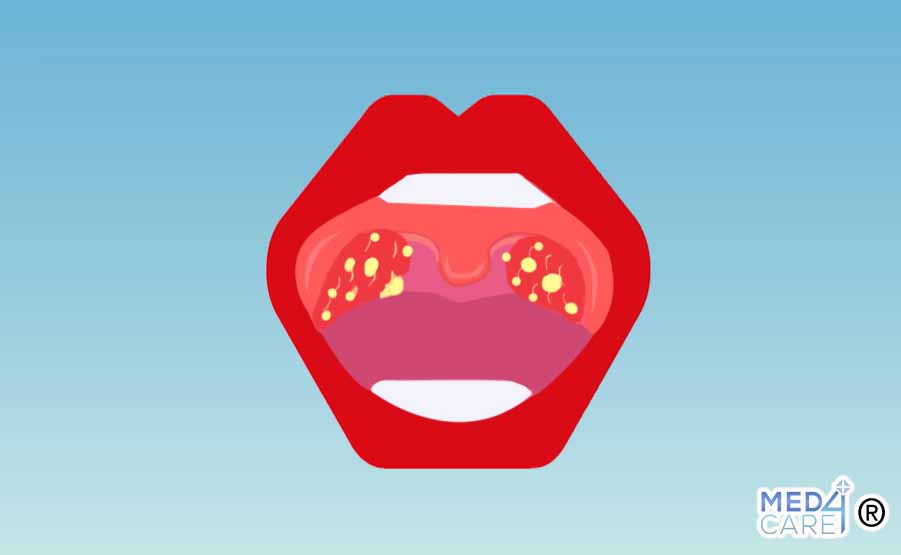 Mononucleosi, malattia del bacio, malattie infettive