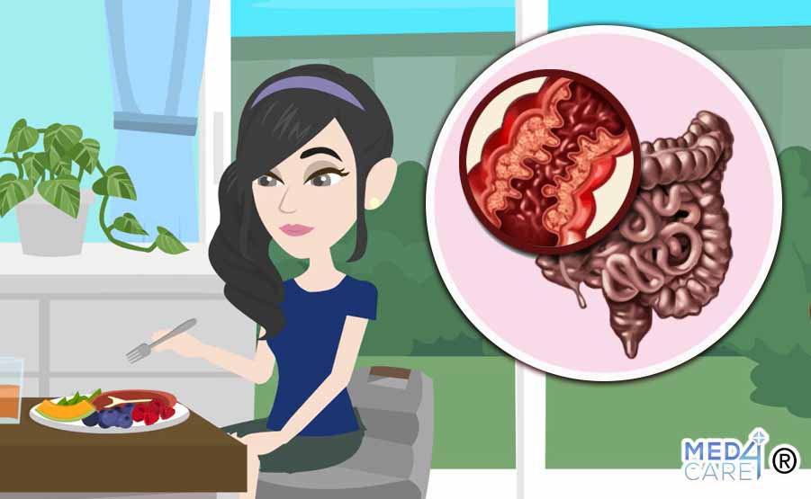 Morbo di Crohn cosa mangiare, alimentazione per il morbo di Crohn