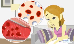 Scopri di più sull'articolo I farmaci impiegati per l’anemia migliorano effettivamente il trasporto dell’ossigeno?