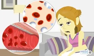 Scopri di più sull'articolo I farmaci impiegati per l’anemia migliorano effettivamente il trasporto dell’ossigeno?