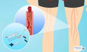Scopri di più sull'articolo PICC e trombosi nei pazienti oncologici: gli score di rischio sono efficaci?
