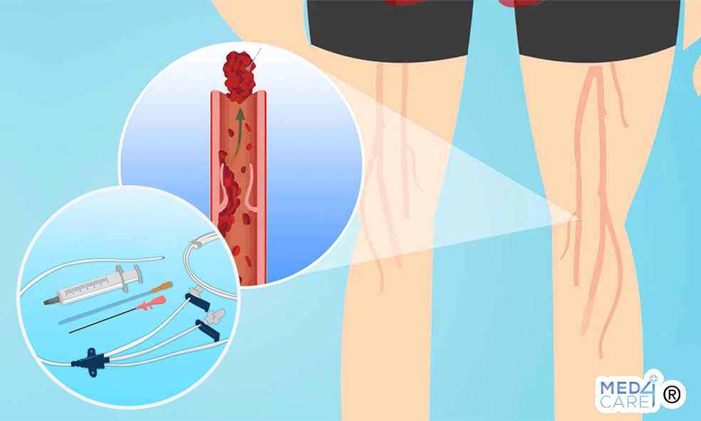 PICC e trombosi, pazienti oncologici, catetere venoso centrale (CVC)