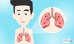 Scopri di più sull'articolo Un nuovo modello predittivo può aiutare a riconoscere i noduli maligni del polmone?