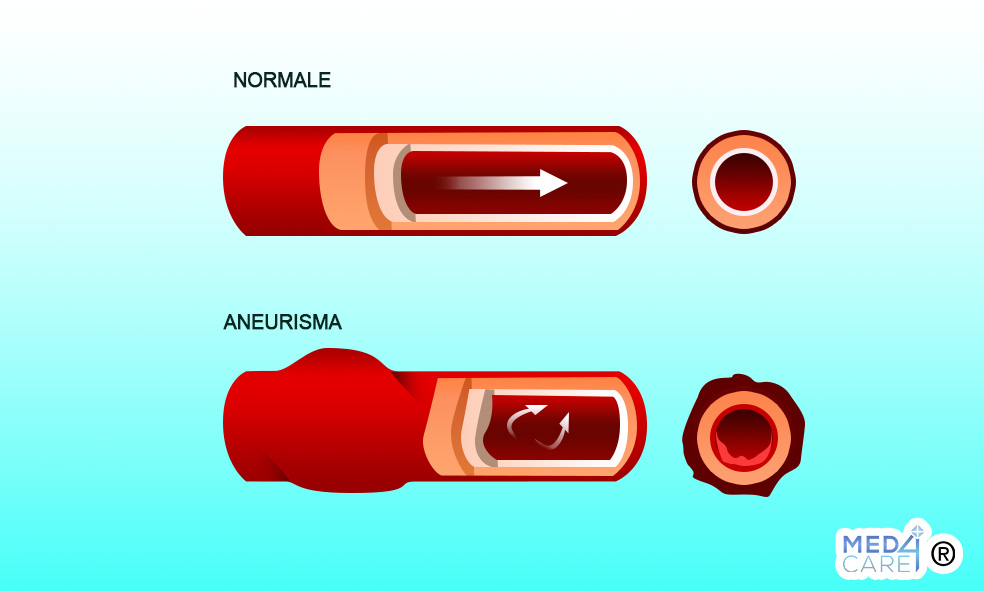 Normale vs Aneurisma