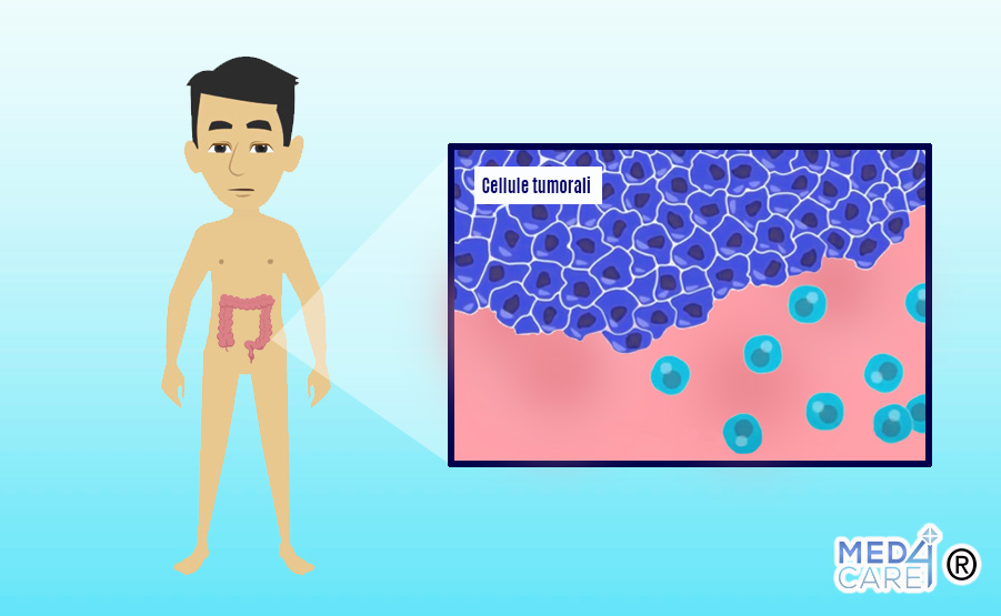 Tecnologia Multicolor AI per il cancro del colon-retto