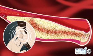 Scopri di più sull'articolo Aterosclerosi carotidea e perdita dell’udito in tarda età: c’è un’associazione?