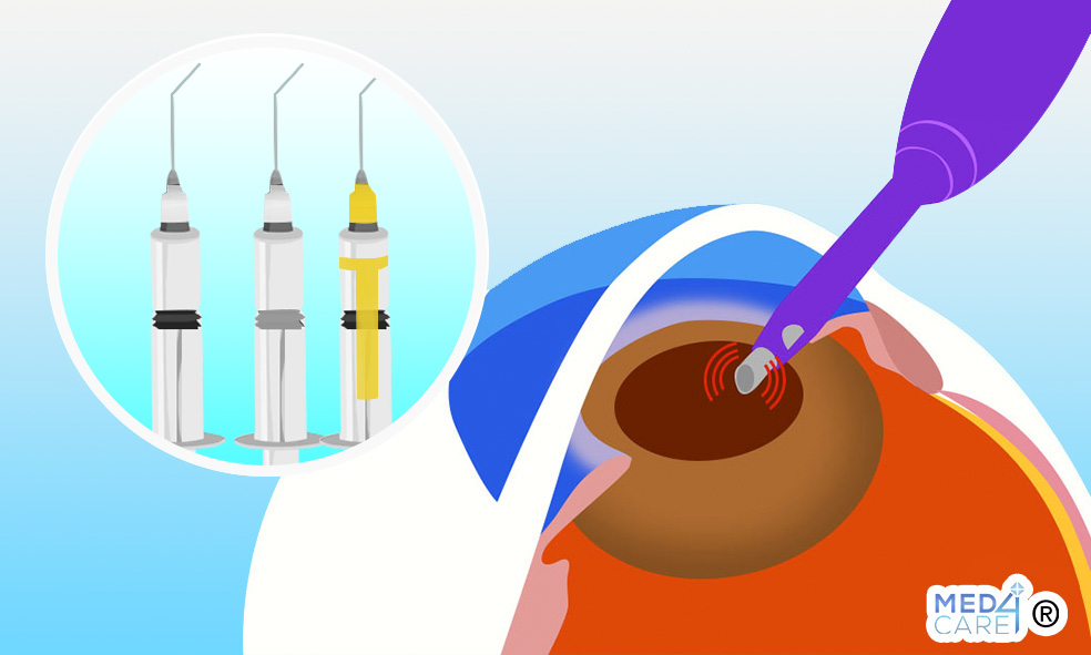 Cataratta intervento facoemulsificazione con o senza OVD, dispositivi oftalmici viscochirurgici