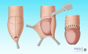 Scopri di più sull'articolo Circoncisione: la rimozione di tessuto del prepuzio
