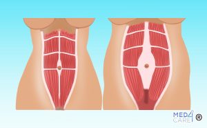 Scopri di più sull'articolo Diastasi addominale: quando i muscoli dell’addome si allargano e perdono il loro tono