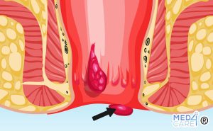 Scopri di più sull'articolo Emorroidi esterne