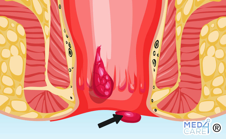 emorroidi, vene, emorroidi esterne