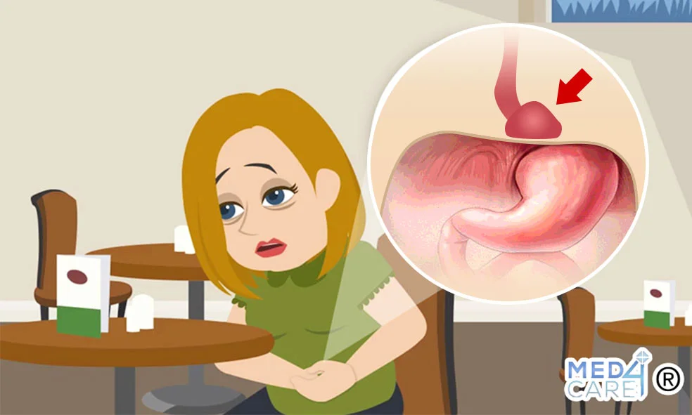 Ernia iatale, gastroenterologia, gastroenterologo, disturbi gastrici