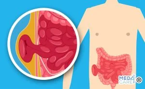 Scopri di più sull'articolo Ernia inguinale