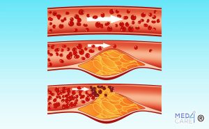 Scopri di più sull'articolo Ischemia