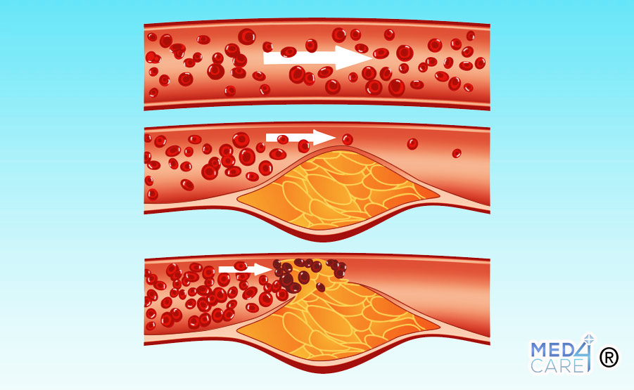 ischemia, malattie cardiovascolari