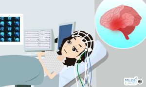 Scopri di più sull'articolo Quanto è utile l’EEG di routine per la prevenzione dell’epilessia?