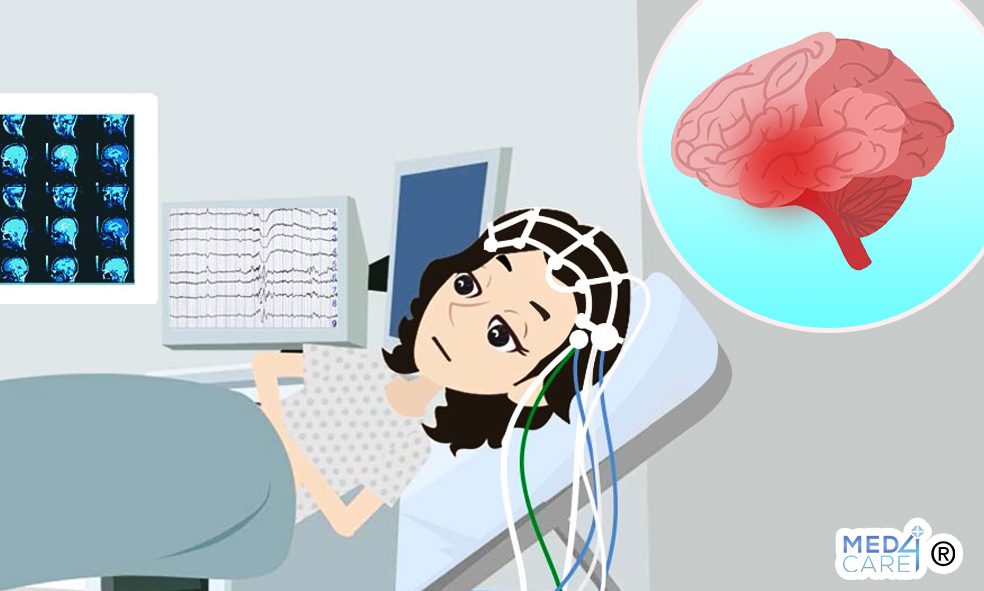 EEG prevenzione epilessia, crisi epilettiche, elettroencefalogramma
