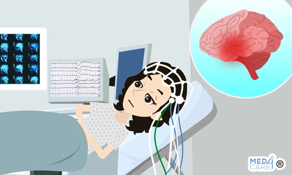 EEG prevenzione epilessia, crisi epilettiche, elettroencefalogramma