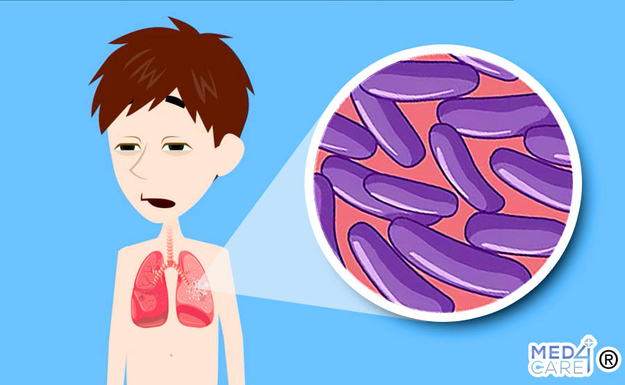 tubercolosi, tb, mycobacterium tuberculosis, infezione polmonare