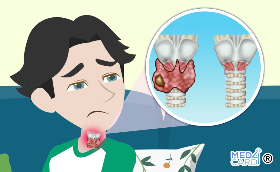 paralisi delle corde vocali dopo tiroidectomia, qualità della vita, tiroidectomia, paralisi delle corde vocali