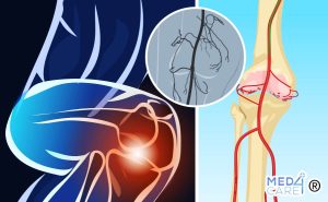 Scopri di più sull'articolo L’embolizzazione delle arterie genicolari è un possibile trattamento per l’osteoartrite?
