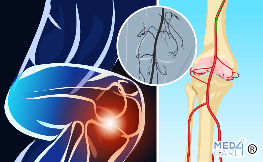 Embolizzazione delle arterie genicolari e osteoartrite, trattamento dell'osteoartrite, osteoartrite