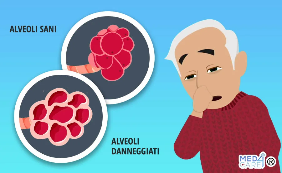 Enfisema uomo alveoli