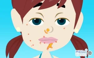 Scopri di più sull'articolo Impetigine