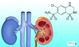 Scopri di più sull'articolo L’idroclorotiazide può essere utile per prevenire la recidiva di calcoli renali?
