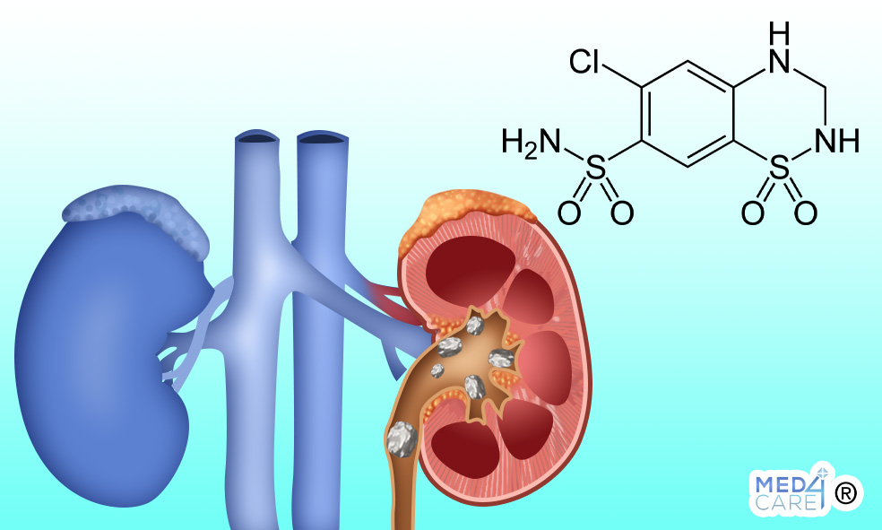 Idroclorotiazide e calcoli renali, recidiva calcoli renali, prevenzione calcoli renali, diuretico tiazidico idroclorotiazide