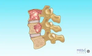 mieloma, midollo osseo