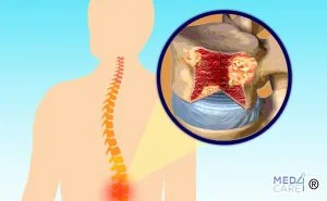 mieloma, midollo osseo