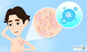 Scopri di più sull'articolo Ozonoterapia per la psoriasi
