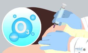 Scopri di più sull'articolo Modalità di somministrazione dell’ozono in medicina