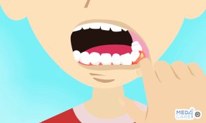 Scopri di più sull'articolo Ascesso dentale
