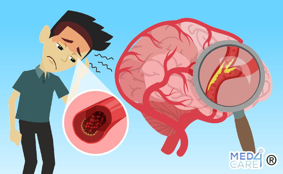 ischemia cerebrale