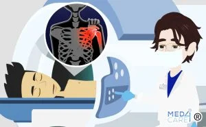 Scopri di più sull'articolo La TC può influenzare la gestione chirurgica dei pazienti con instabilità anteriore della spalla?
