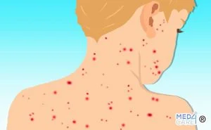 Scopri di più sull'articolo Morbillo