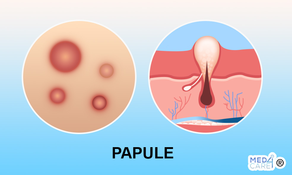 orticaria papule