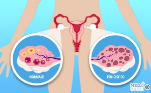 Scopri di più sull'articolo Ovaio policistico