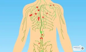 Scopri di più sull'articolo Linfonodi